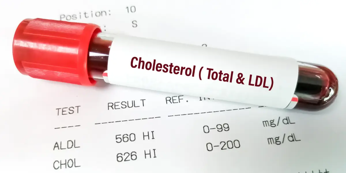 Resultado de exame após Sintomas de Colesterol Alto